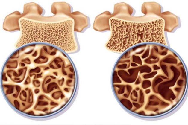 Osteoporosi e veganesimo