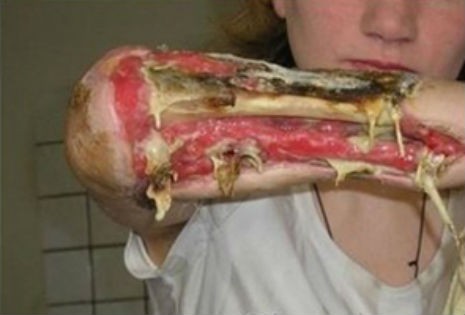 Nuove droghe: allarme Krokodil